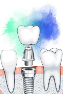 Dental implant special offer.