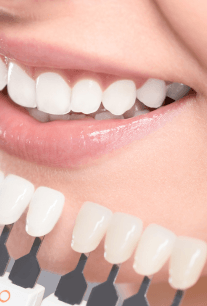 Dental teeth whitening spacial offer.